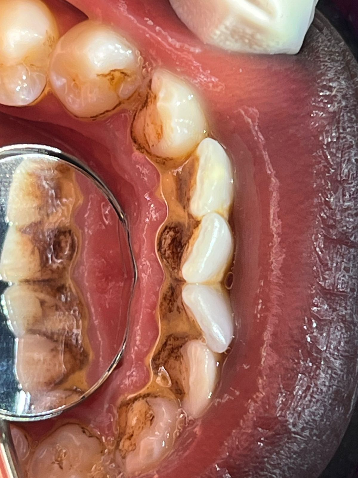 Destartarização + Lavagem